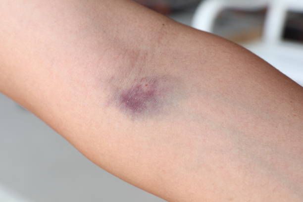 Why Do I Bruise So Easily After A Blood Test Riversource Training 